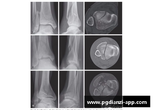 球员踝骨骨折：原因、治疗及康复全解析